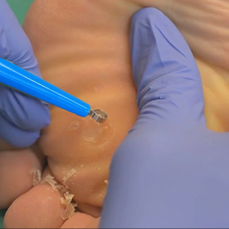 Debriding verruca with dermal curette