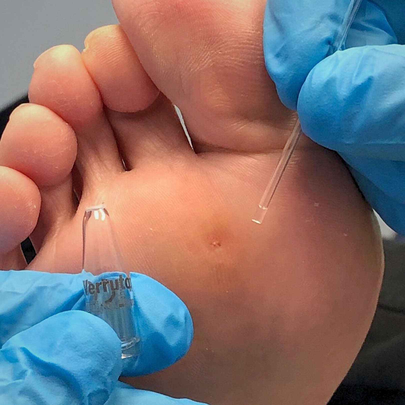 Verrutop application on foot