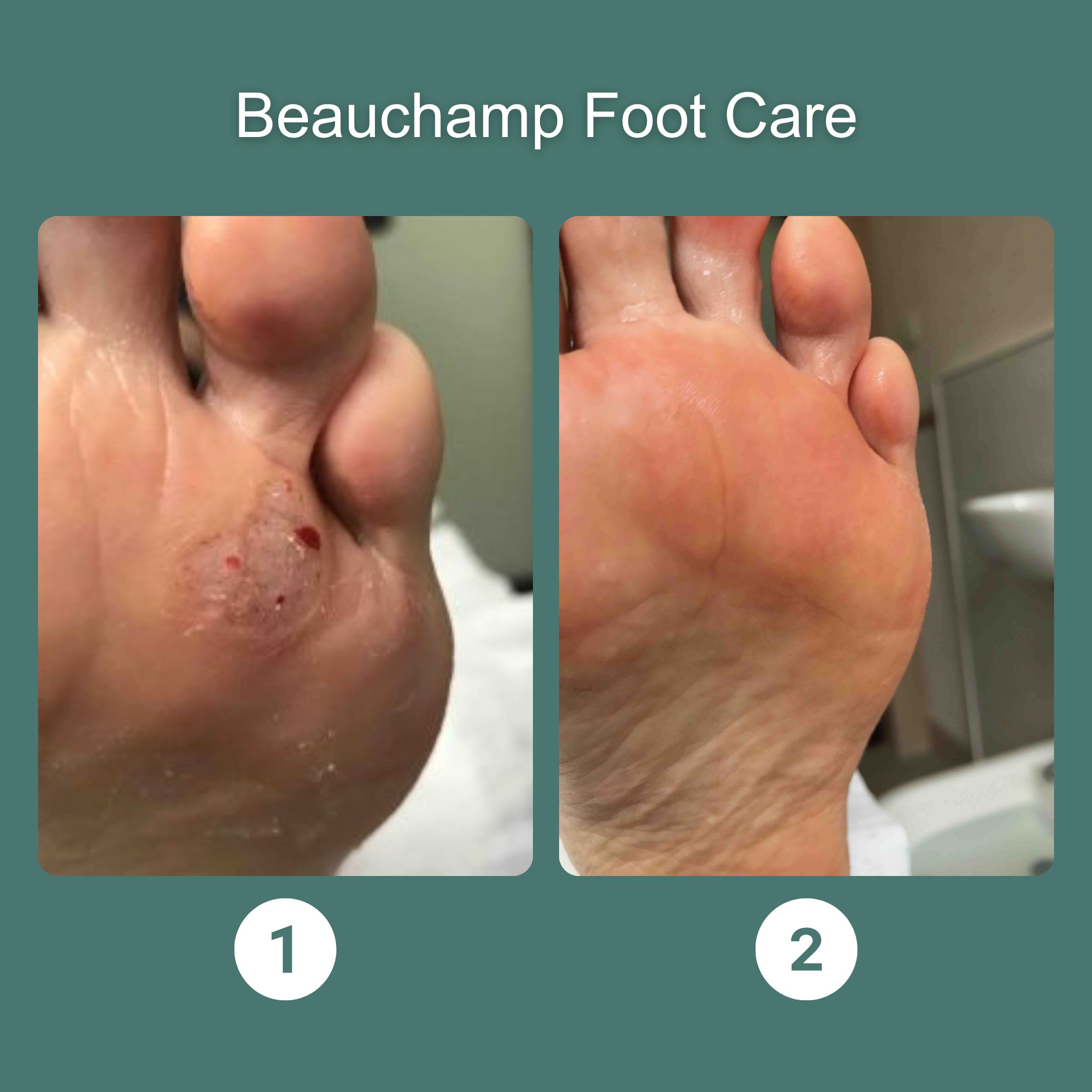 Before and after Verrutop treatment showing successful disappearance of verruca following treatment