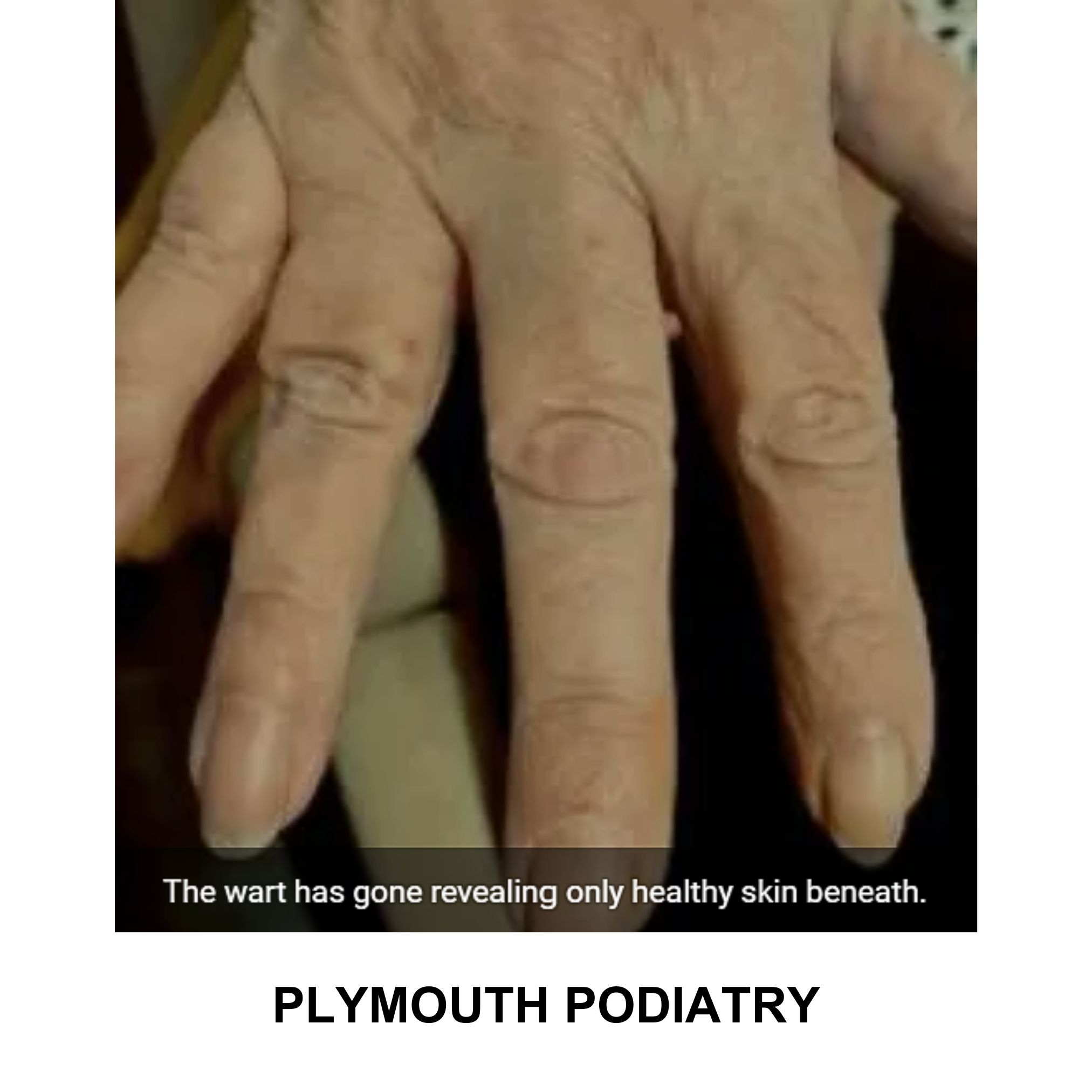 Completely treatment wart after verrutop treatment