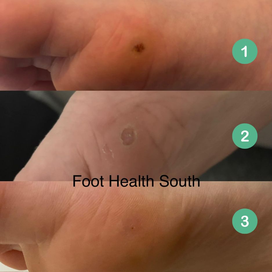 Before and after images of a verruca on a child&rsquo;s foot treated with Verrutop, showing clear skin after treatment.