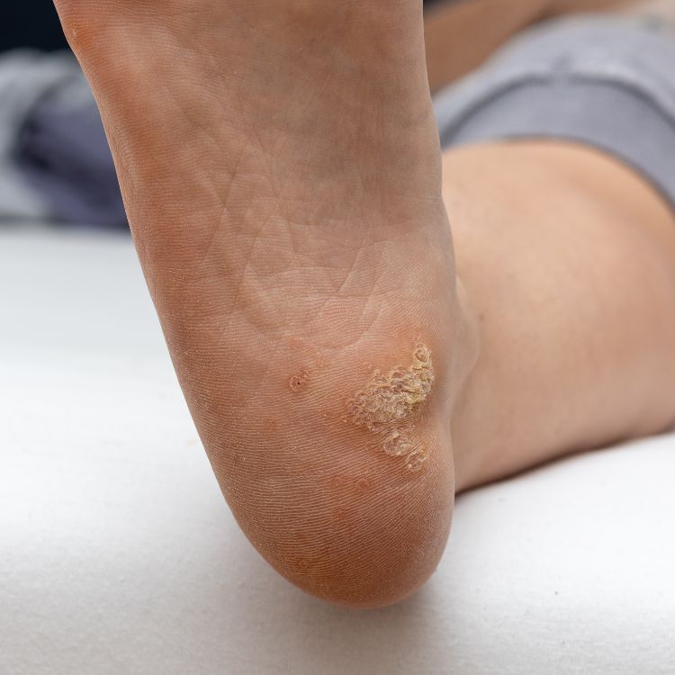 A photo of Plantar wart
