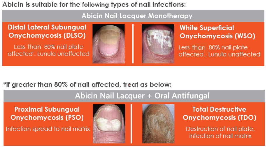Abicin for fungal nail treatment