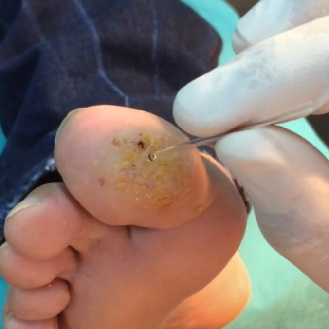 Applying verrutop on a foot