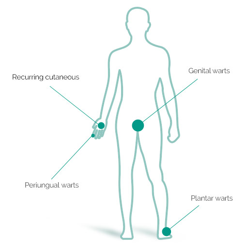 What types of warts can verrutop be used to treat?